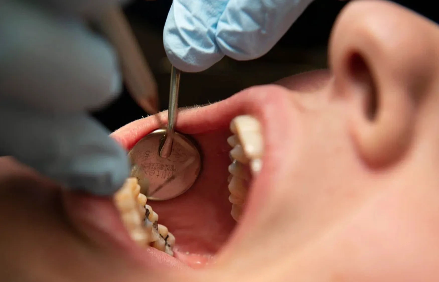 FDA restricts use of kids' fluoride supplements citing emerging health risks